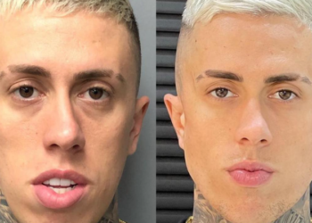 Confira o antes e depois dos MCs que fizeram harmonização facial