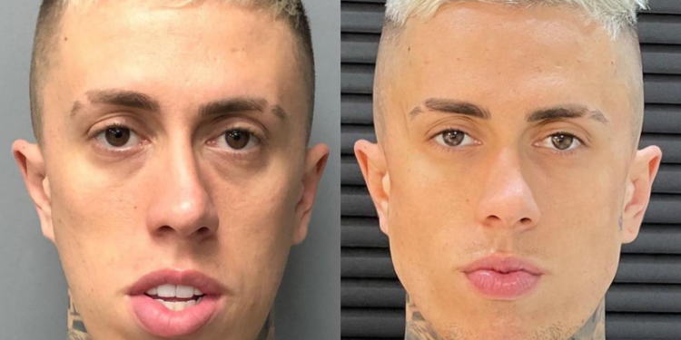 Confira o antes e depois dos MCs que fizeram harmonização facial